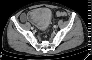 Colon cancer: Generalized peritoneal pigmentation