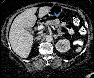Insulinoma: Enucleation