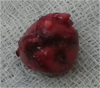 Insulinoma: Enucleation