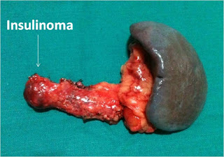 Insulinoma: Enucleation