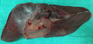 Surgery for intrahepatic cholangiocarcinoma (IHC)
