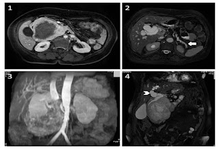 Ascites following Whipple's procedure