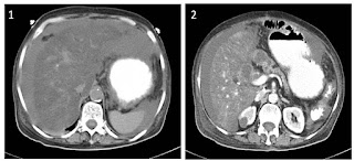 Ascites following Whipple's procedure (Pancreatoduodenectomy)