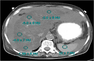 Ascites following Whipple's procedure