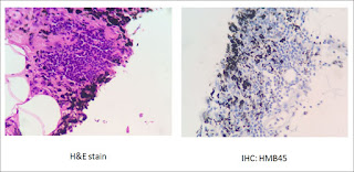 Colon cancer: Generalized peritoneal pigmentation