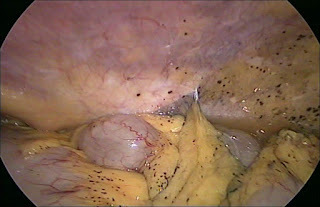 Colon cancer: Generalized peritoneal pigmentation
