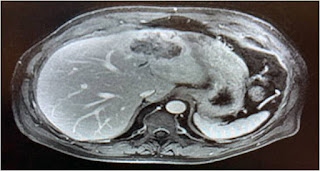Surgery for intrahepatic cholangiocarcinoma (IHC)