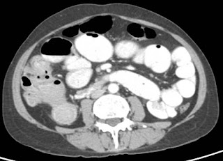 Surgery for colorectal cancer (CRC)