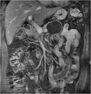 Mucinous Cystic Neoplasm (MCN) of Pancreas