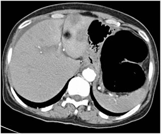Surgery for colorectal cancer (CRC)