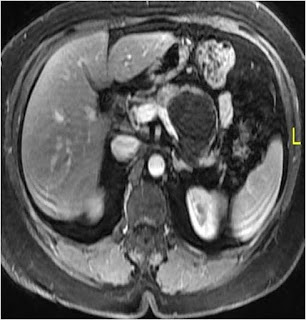 Mucinous Cystic Neoplasm (MCN) of Pancreas