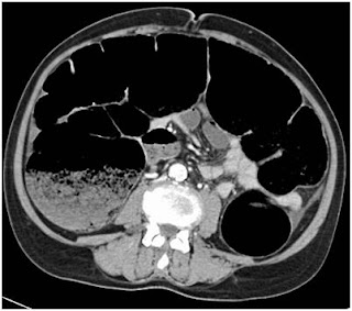 Abdominal CT scan showing closed obstruction of large bowel