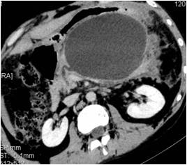 Mucinous Cystic Neoplasm (MCN) of Pancreas