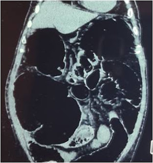 Surgery for colorectal cancer (CRC)